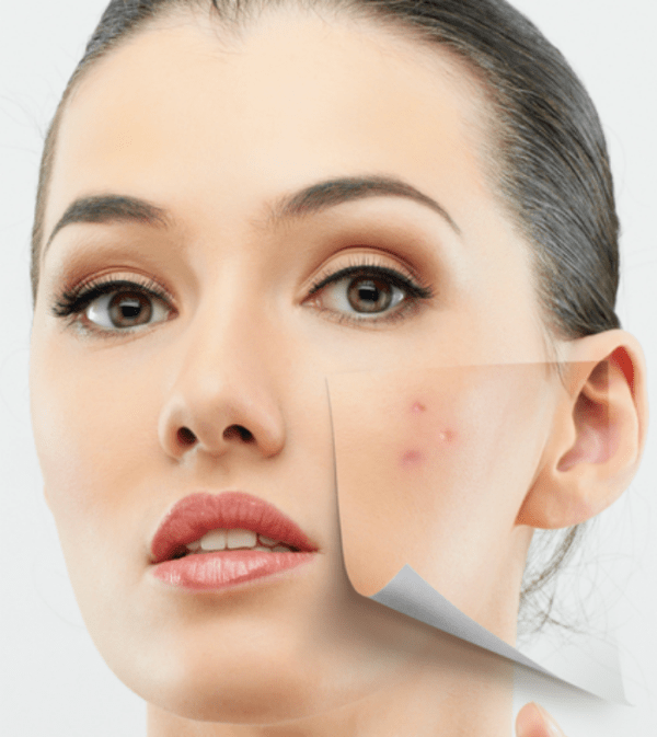 Choose your chemical peel – guide